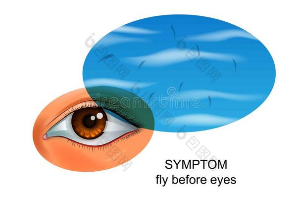 苍蝇在之前眼睛.症状关于眼睛疾病
