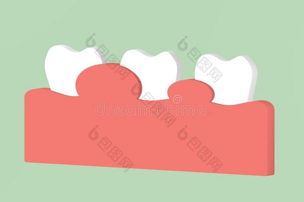 齿龈炎或牙齿周围的疾病,炎症关于指已提到的人口香糖组织