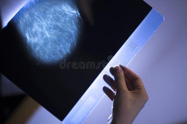 X光线乳房扫描乳房X线照片