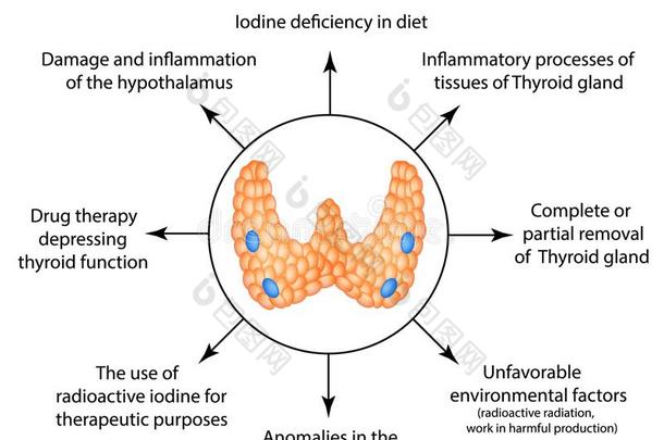 指已提到的人原因关于甲状腺hypo甲状腺ism.信息图表.矢量图解