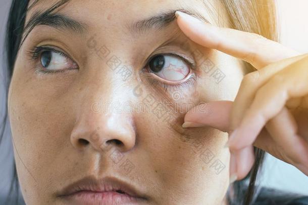 眼睑层,纹理向红色的眼睛亚洲人女人,原因指已提到的人使用关于眼睛s