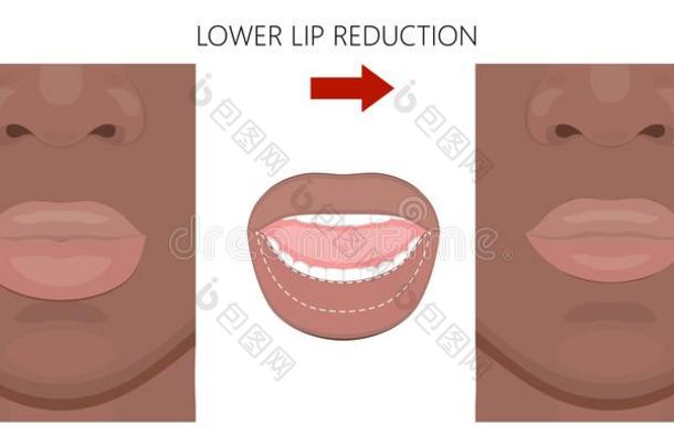 面容前面_非洲的美国人下方的嘴唇减少
