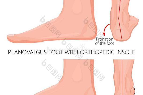 平的脚和整形手术的鞋内底_Exretnal韦夫