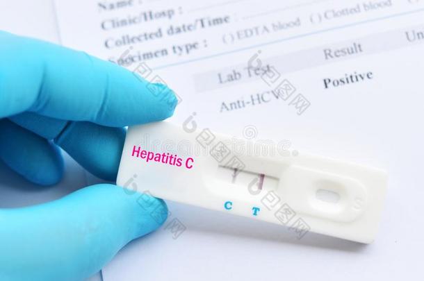 <strong>肝炎</strong>英语字母表的第3个字母病毒积极的试验结果