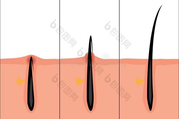 正常的和向内生长的头发矢量说明