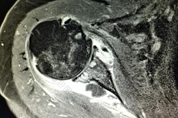肩膀burcitis盂肱的骨关节炎