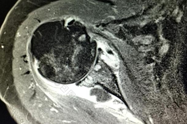 肩膀burcitis盂肱的<strong>骨关节</strong>炎
