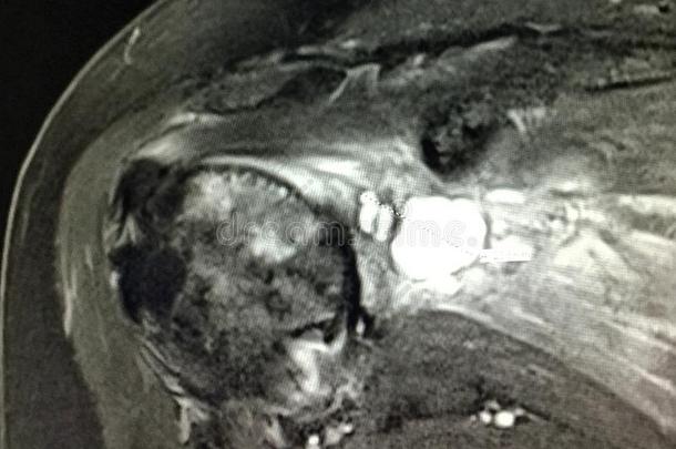 肩膀滑囊炎盂肱的骨关节炎