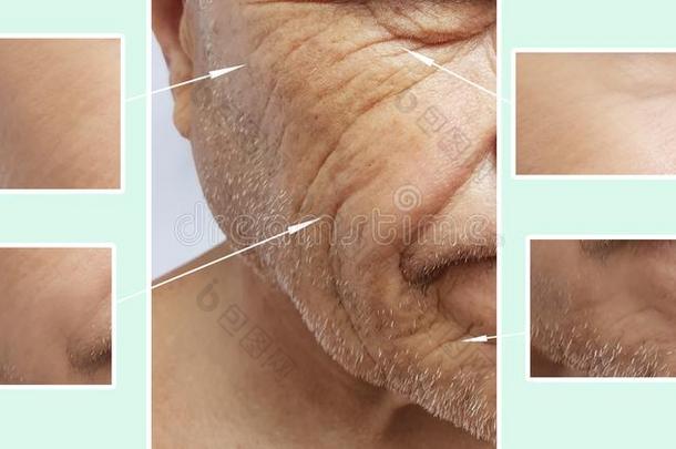 男人上了年纪的面容皱纹在之前和后的治疗外科学专业人员