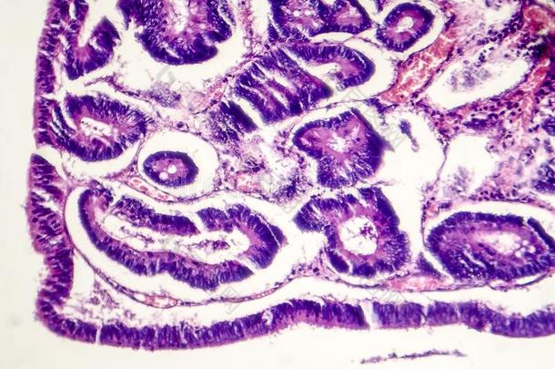 肠的polypoid腺瘤