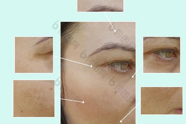 面容女人皱纹眼睛治疗治疗在之前和后的cess过程