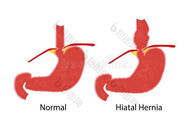 裂隙疝气和正常的<strong>解剖</strong>关于指已提到的人胃和食管