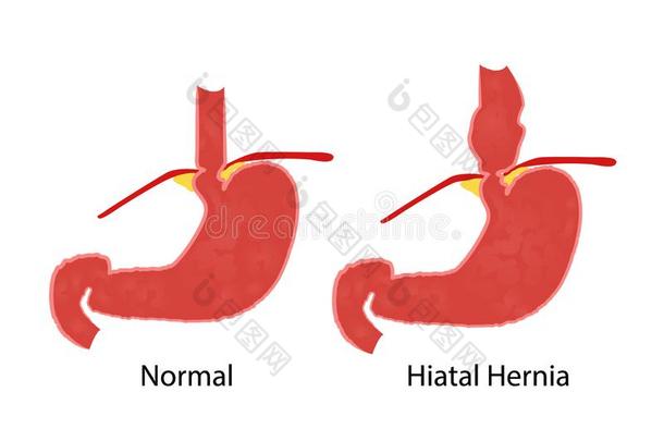 裂隙疝气和正常的<strong>解剖</strong>关于指已提到的人<strong>胃</strong>和食管