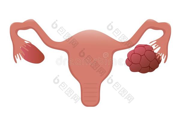 多囊的卵巢矢量说明