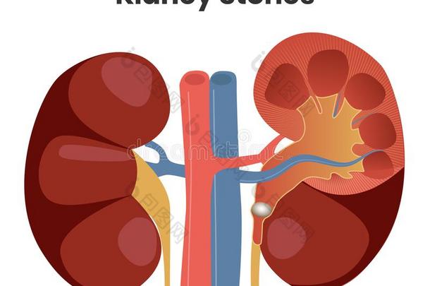 矢量说明关于指已提到的人<strong>肾</strong>石头.障碍物关于指已提到的人抱朴说