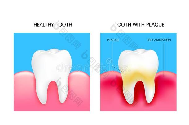 <strong>牙齿</strong>的匾额和<strong>炎症</strong>和健康的牙.