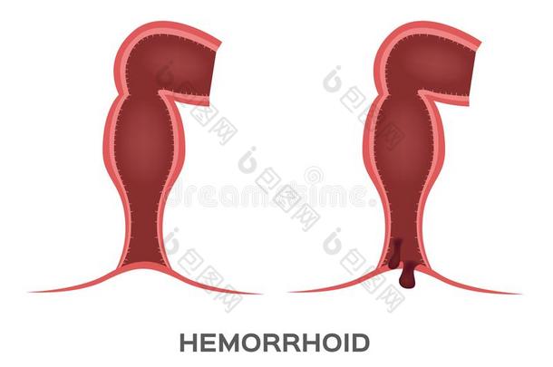 痔疮阶段.和肛门