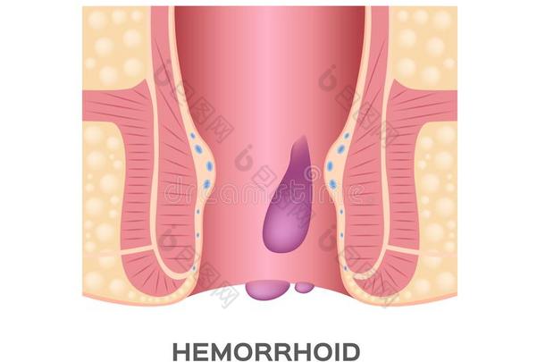 痔疮阶段.和肛门