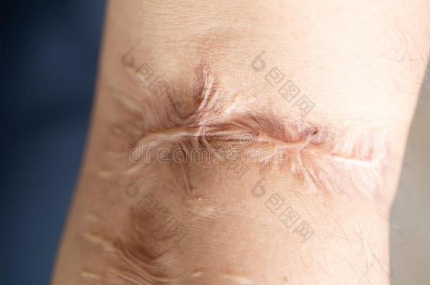 一伤痕是（be的三单形式一地区关于含纤维的t是（be的三单形式suedet.那个取代正常的皮.
