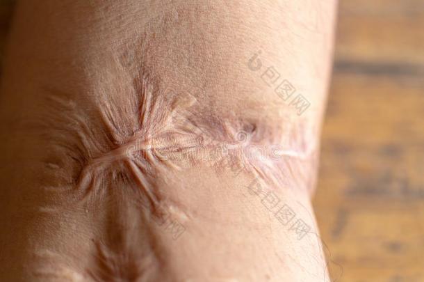 一伤痕是（be的三单形式一地区关于含纤维的t是（be的三单形式suedet.那个取代正常的皮.
