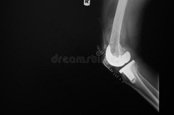 字母x-射线影像关于灯笼后方向右膝共同的和总计的膝