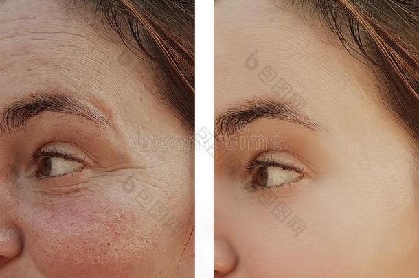 女人<strong>眼睛皱纹</strong>在之前和后的皮肤病化妆品程序