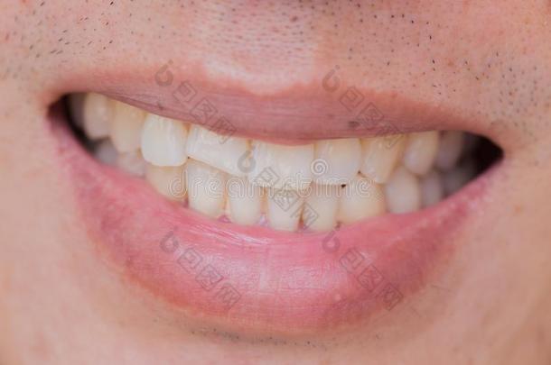 难看的微笑牙齿的问题.牙伤害或牙破坏采用英语字母表的第13个字母