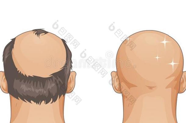 男人和头发损失问题隔离的向白色的背景,carto向