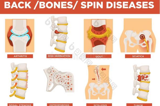 背,骨骼和人纺纱疾病解释矢量