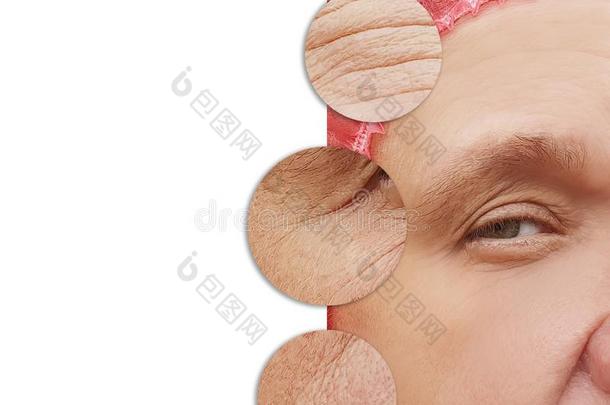 成熟的女人面部的皱纹防衰老的在之前和后的程序