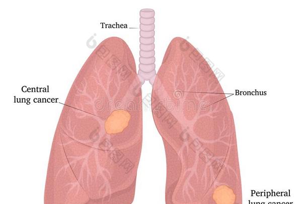位置关于肺癌症