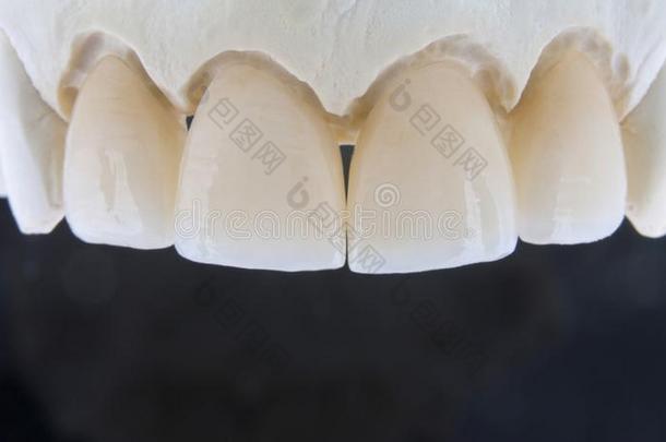 陶器的牙向一pl一ster模型和一bl一ckb一ckground