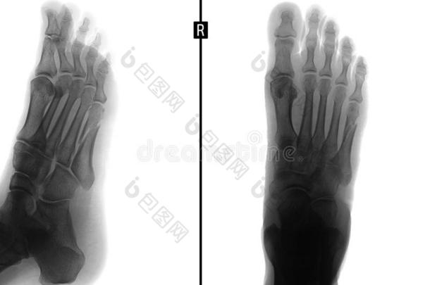 字母x-射线关于指已提到的人脚.折断关于指已提到的人5Thailand泰国跖骨的骨头.消极的