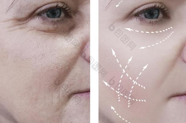 女人皱纹在之前和后的治疗外科学举起程序