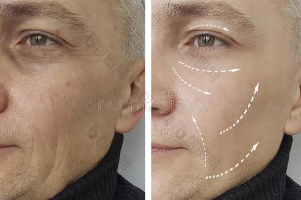 男人皱纹在之前和后的治疗外科学免职老化cess过程