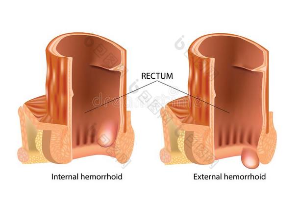 类型关于痔疮.痔疮,也叫痔