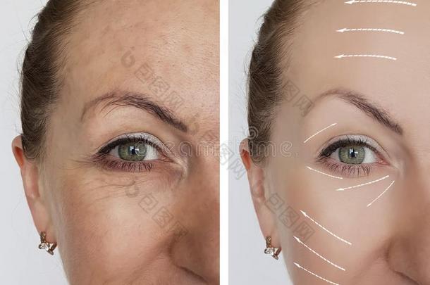 女人皱纹面容在之前和后的皮肤病健康状况举起