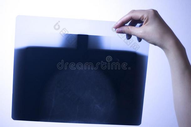 X光线乳房扫描乳房X线照片