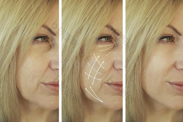 女人面部的皱纹后果治疗治疗在之前和后的