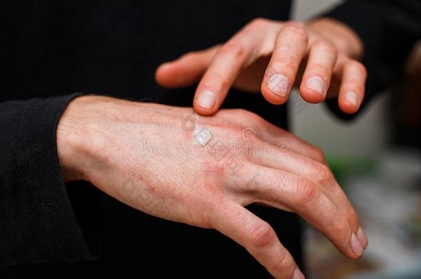 擦过敏的皮从湿疹或ps或iasis和应用甾类化合物