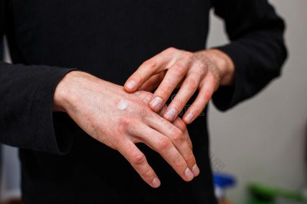 擦过敏的皮从湿疹或<strong>ps</strong>或iasis和应用甾类化合物