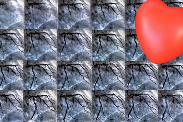 插管术.<strong>心脏</strong>的脑室造影术和小的红色的心