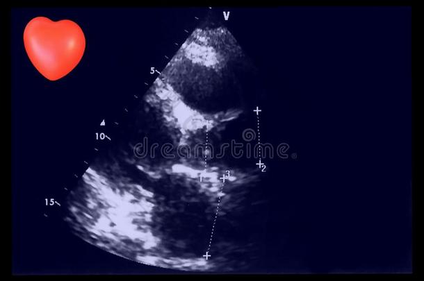 心脏的超声比喻和小的心.多普勒的<strong>回</strong>声