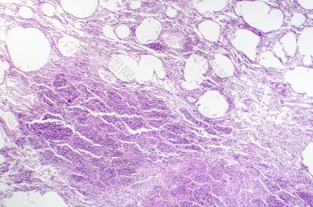 组织病理学说关于空隙的肺炎