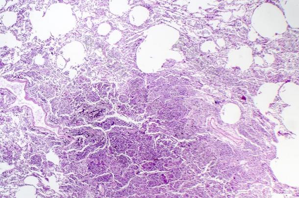 组织病理学说关于空隙的肺炎