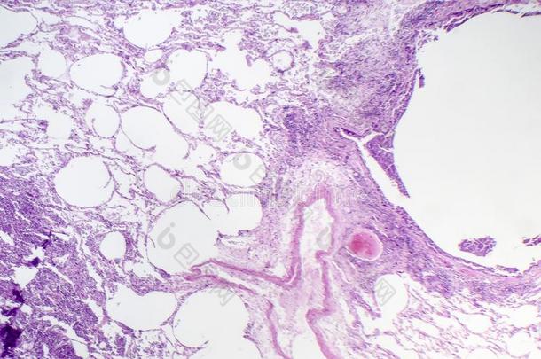 组织<strong>病理</strong>学说关于空隙的肺炎