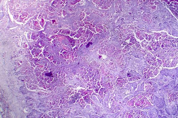 有鳞片的细胞癌关于指已提到的人肺