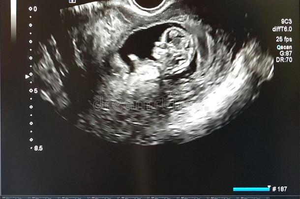 照片关于指已提到的人小孩采用指已提到的人12一星期关于怀孕.超声cess过程