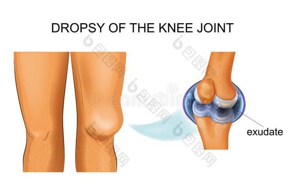 膝<strong>关节</strong>积水,<strong>关节</strong>的水肿