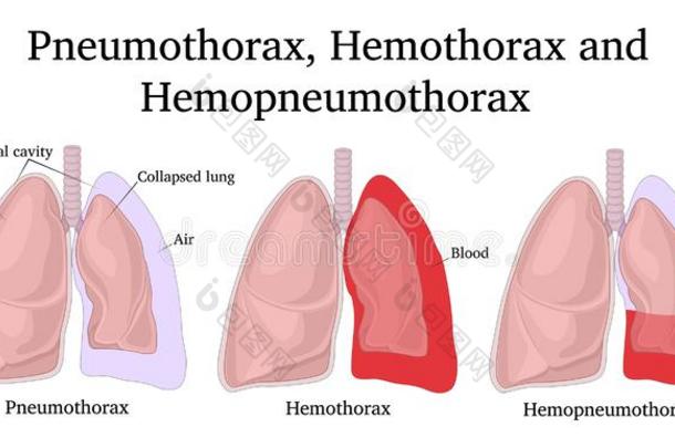 说明关于气胸,血胸和血气胸